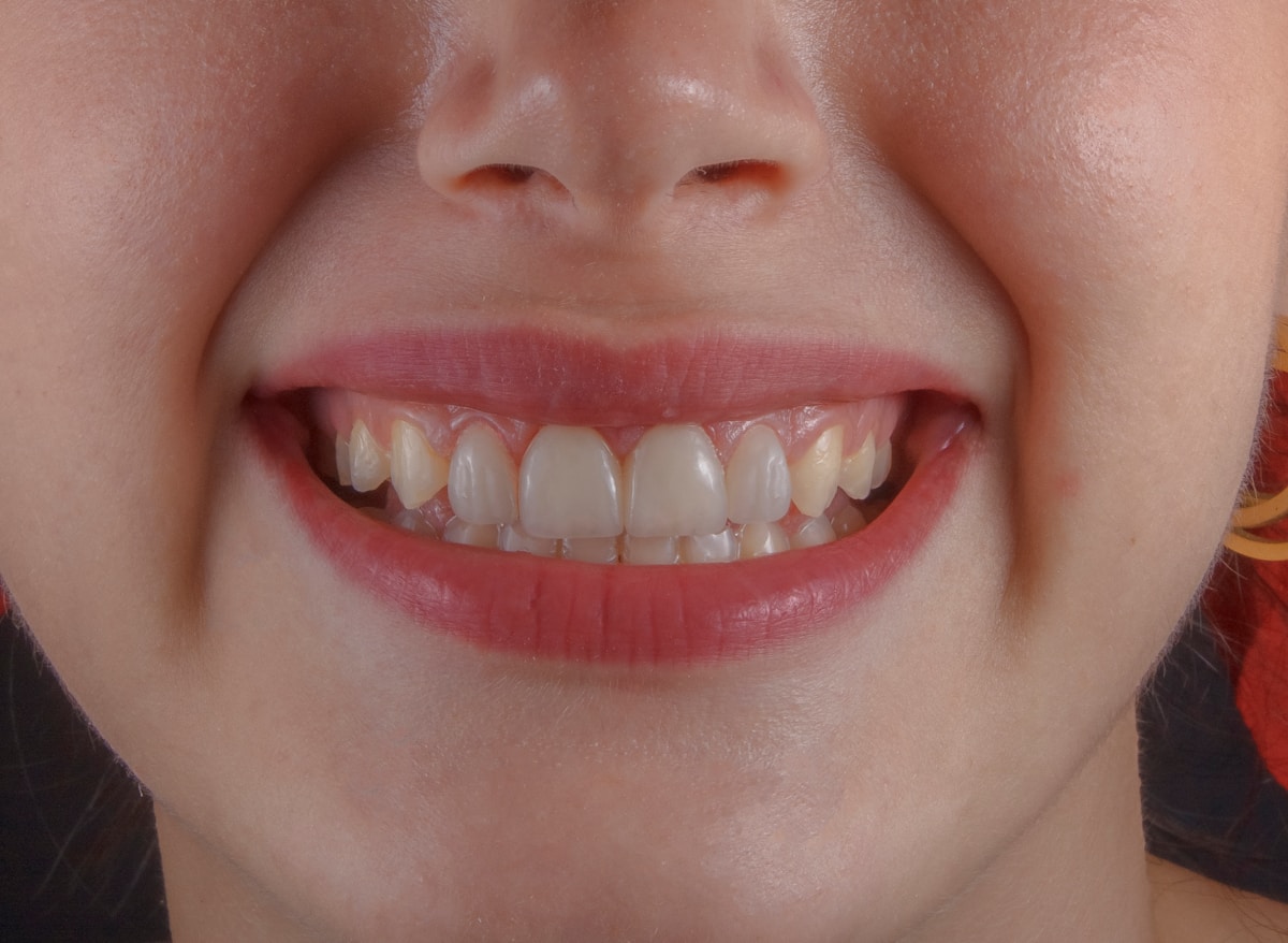 Detaj buze para trajtimit estetik