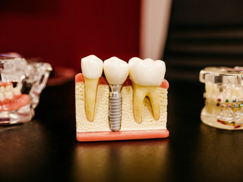 Model implanti dentar me strukturë titani