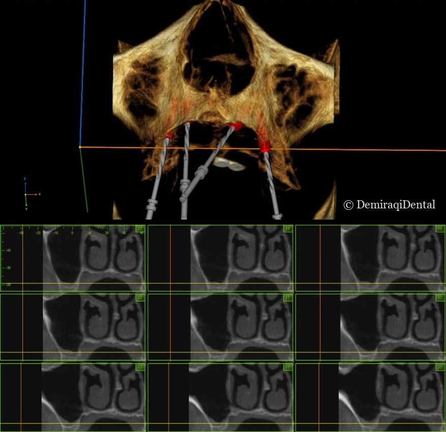 Planifikim dixhital 3D i implanteve mbi një CBCT, me prerjet tërthore